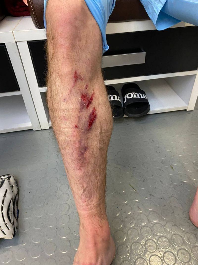 ЦСКА показал, как выглядит нога Акинфеева после столкновения с Конате